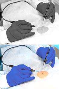 Skin & Soft Tissue Surgery provided by Jihan Hegazy, MD, FACS - Modesto General Surgeon  - Minimally Invasive Surgery 
